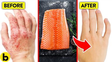 EAT THIS, Not This To Help Stop Eczema | Warning Signs Of Eczema 6 1680372562 maxresdefault