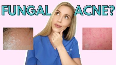 Do YOU have Fungal Acne? | Dermatologist Talks Symptoms and Treatments! 6 1680378799 maxresdefault