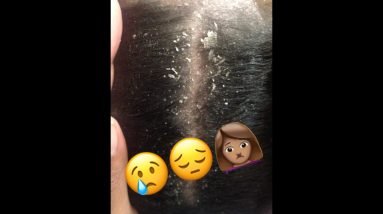 How To| Eczema in Scalp for Toddler, No More Suffering |NATURAL HAIR 2 1680380314 maxresdefault