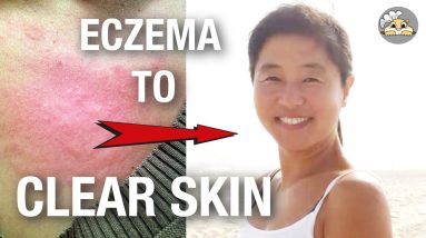 Eczema to Clear Skin (my story) 20 1680380993 maxresdefault