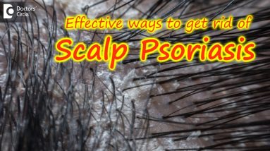 Scalp psoriasis:Symptom, Cause, Treatment | Safe ways to Wash Hair -Dr. Rasya Dixit| Doctors' Circle 16 1680381728 maxresdefault