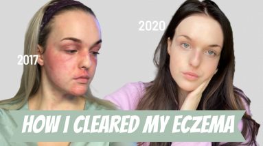 How I Cleared my Severe Eczema | Tips for Healing (re-upload) 14 1680382359 maxresdefault