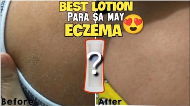 BEST LOTION FOR PEOPLE WITH ECZEMA | Eka Pagunaling 10 1680383268 maxresdefault