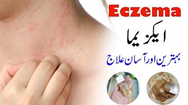 Eczema and Psoriasis Treatment Natural Home Remedies Urdu Hindi 8 1680384276 maxresdefault