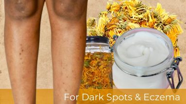 WHIPPED BODY BUTTER FOR DRY SKIN, BODY ACNE, DARK SPOTS, SCARS, ECZEMA, & KERATOSIS PILARIS 6 1680384844 maxresdefault