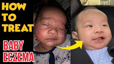 How to treat BABY ECZEMA 100% Effective and Organic! 14 1680387973 maxresdefault