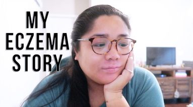 SKIN STORY: LIVING WITH ECZEMA // Sheri Ann 6 1680390935 maxresdefault
