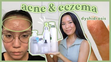 How I Treat My Acne & Eczema ๐งด Skincare Faves + Tips (redness, texture, dyshidrosis) 10 1680395468 maxresdefault