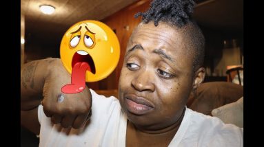 What is eczema dermatitis? 20 1680397533 maxresdefault