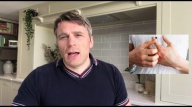 How to treat eczema, its causes and symptoms by Doctor Andrew Hogg 8 1680400410 hqdefault