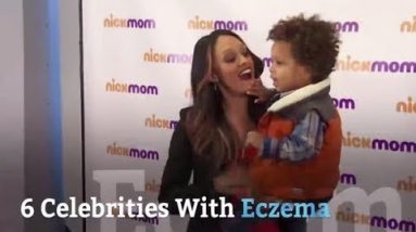 6 Celebrities With Eczema | Health 14 1680404448 hqdefault