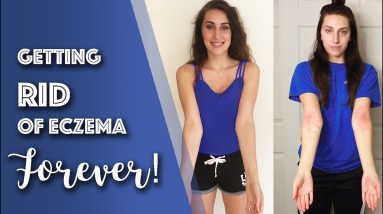 How I CURED my Eczema in 6 Months! 5 Diet Tips 2 1680408698 maxresdefault