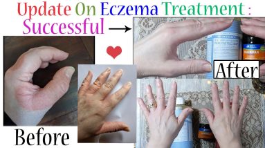 Update on my hand Eczema treatment: It was successful!! With before and after photos. 2 1680413427 maxresdefault
