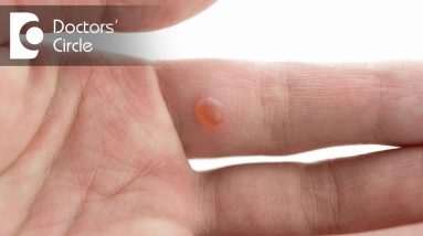 Possible causes of 'White hard bumps' on hands & fingers with its management - Dr. Rasya Dixit 20 1680414497 maxresdefault