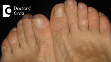 What causes itching, scaly lesions in webs of finger and toes? - Dr. Sudheendra Udbalker 6 1680418325 maxresdefault