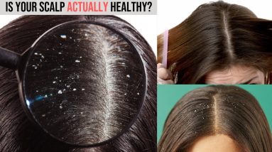 How to Treat Dandruff, Dermatitis, or Scalp Psoriasis | Causes, Symptoms, and Treatments. 18 1680420582 maxresdefault