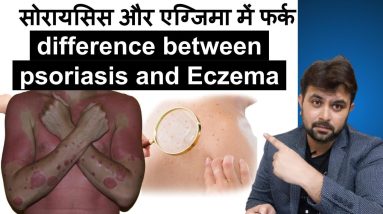What is the difference between psoriasis and Eczema | सोरायसिस और एग्जिमा में फर्क 16 1680420883 maxresdefault