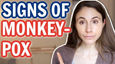 MONKEYPOX OUTBREAK: SIGNS & SYMPTOMS NOT TO MISS 😮 DERMATOLOGIST @DrDrayzday 12 1680422018 maxresdefault
