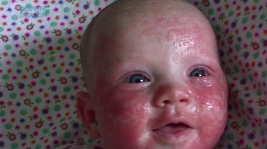 Baby Eczema - Acne on Newborn's face. Food Allergy Symptoms 8 1680423053 maxresdefault