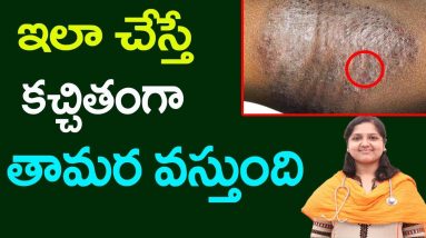 ఇలా చేస్తే కచ్చితంగా తామర వస్తుంది Eczema Causes | Ringworm Telugu | Tamara | Skin Health TipsTelugu 4 1680424311 maxresdefault