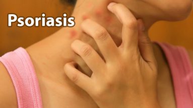 What is Psoriasis / eczema? 2 1680424813 maxresdefault