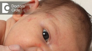 What can I do for my 5 month old son's Atopic Dermatitis at home? - Dr. Rashmi Ravindra 8 1680428481 maxresdefault