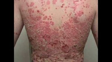 Eczema Vanished Review 6 1680428987 hqdefault