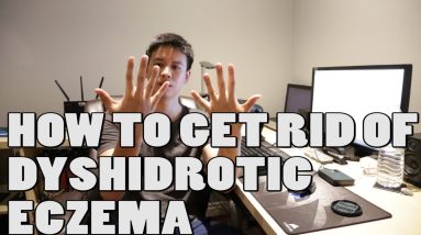 How to Get Rid of Dyshidrotic Eczema 4 1680429442 maxresdefault
