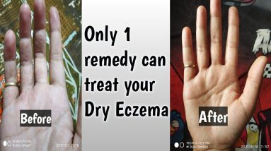 My Eczema journey || allergic dermetitis ||Hands care in covid situation || #priyankayadav 16 1680431686 maxresdefault