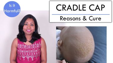 How to get rid of Cradle Cap in Babies? Is it contagious? 10 1680433132 maxresdefault
