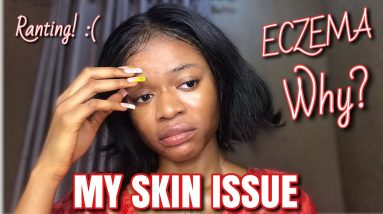 Ranting about my skin reaction, causes, treatment | Hypopigmentation/eczema | NEED HELP! | MS JOVOU 8 1680440692 maxresdefault