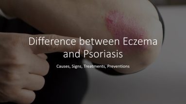 Difference between Eczema and Psoriasis 4 1680446055 maxresdefault