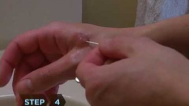 How to Treat Blisters 14 1680449579 hqdefault
