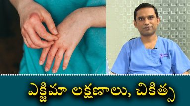 Eczema Symptoms and Causes | ఎక్జిమా లక్షణాలు, చికిత్స 16 1680454740 maxresdefault