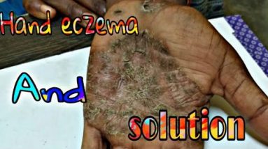Hand eczema and it’s Prevention & Treatment हाथ में एक्ज़ेमा 12 1680456409 hqdefault