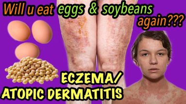 SOYBEAN ALLERGY?| EGG ALLERGY?| ECZEMA |ATOPIC DERMATITIS |ATOPIC ECZEMA | HEALTH AND WELLNESS 8 1680457679 maxresdefault