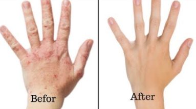 How to Care for your Skin with Baking Soda – Baking Soda for Skin Rashes 18 1680466170 hqdefault
