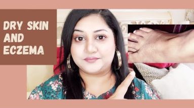How to cure Eczema at home | Intense dry skin | Real Story real experience | Romiza Khan 10 1680467477 hqdefault