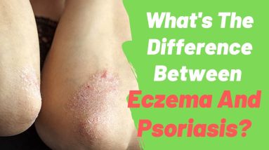 Whats The Difference Between Eczema And Psoriasis? 8 1680468687 maxresdefault