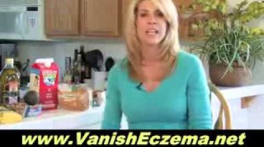 Eczema Clinical Trials - What Causes It and How to Cure It 6 1680469393 hqdefault