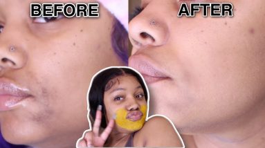 How I LIGHTENED MY ECZEMA SCARS in 7 Days with Tumeric Mask 18 1680471036 maxresdefault
