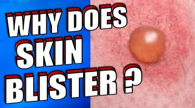 Why Does Skin Blister | How To Treat & Prevent Skin Blisters Naturally 10 1680473505 maxresdefault