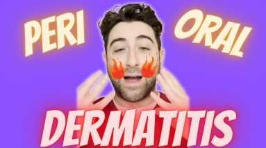What is PERIORAL DERMATITIS ? 12 1680483701 maxresdefault