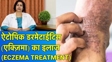 एक्ज़िमा / एलर्जी दाद खाज खुजली का ईलाज || Eczema Treatment 6 1680490347 maxresdefault