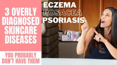 Eczema, Rosacea, Psoriasis OH MY! | 3 Overly Diagnosed Skincare Diseases You Probably Don't Have! 14 1680493456 maxresdefault