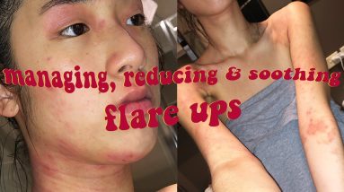 5 Eczema Tips You Haven't Tried 20 1680497601 maxresdefault