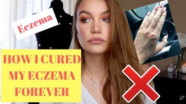 HOW I CURED MY ECZEMA FOREVER 4 1680501528 maxresdefault