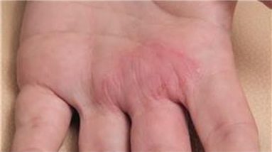 Dermatology Treatments : How to Diagnose Skin Rashes 18 1680503703 hqdefault
