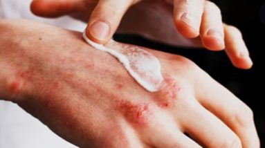 Best Remedies to Treat Eczema | Natural Health 12 1680504985 maxresdefault