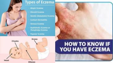 What is Eczema | Eczema Signs and Symptoms | Eczema Diagnosis and Treatment | YoYo Swag 8 1680506372 maxresdefault